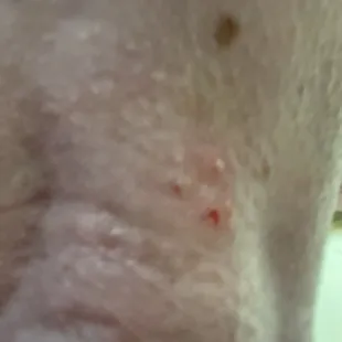 Bed bug bites