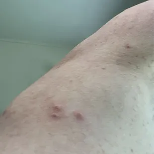 More bed bug bites