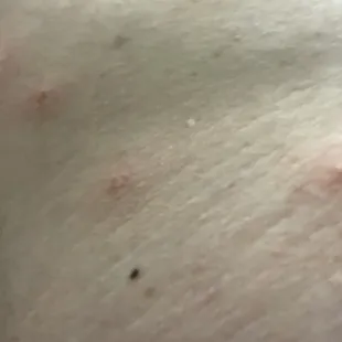 Bed bug bites