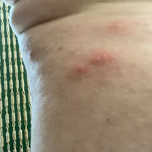Bed bug bites