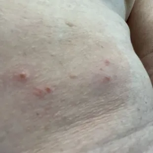 Bed bug bites