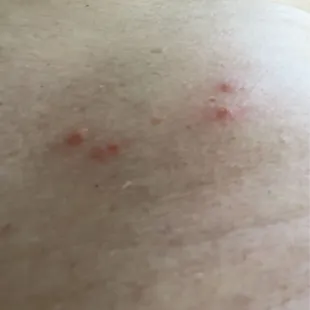 Bed bug bites