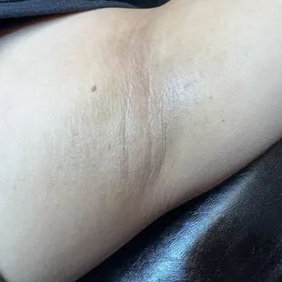 Under arm and intimate brightening treatment