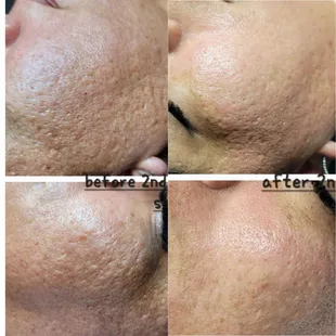 Before and after microneedling session #2