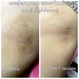 Before and after skin resurfacing
