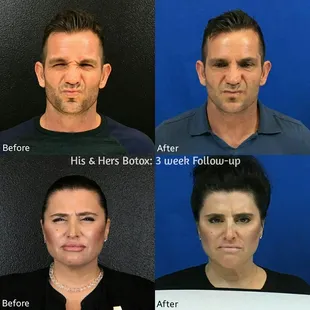 His &amp; Hers Botox: 3 week Follow-up