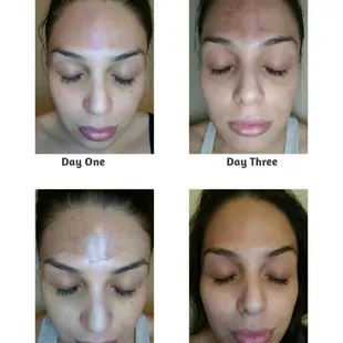 Before &amp; After: One week after the VI Peel