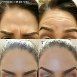 Before &amp; After Botox and SkinMedica AHA/BHA Cleanser (3 week difference)