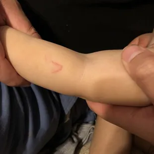 Rooster pecked my 1 year old.
