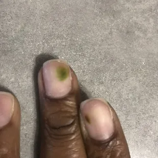 Fungus on nails