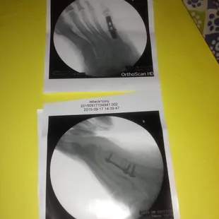 Post surgery. Bracket and screws, ready to heal properly.