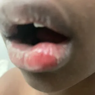 Our son's busted lip.