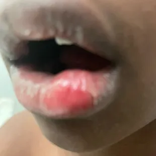 Our son's busted swollen lip.