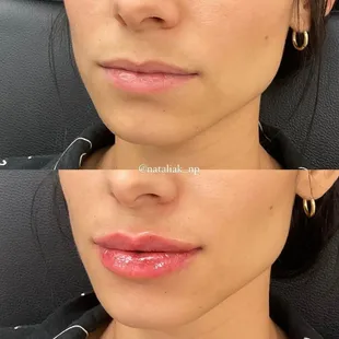 Lip Filler