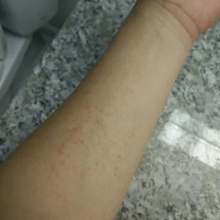 Itchy red bumps all over my body after my massage