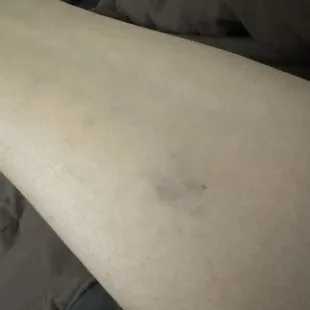 Bruise by security guards at Nova.