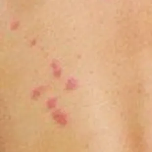 Bed Bug Bites on my back from my stay at Oakhurst Lodge