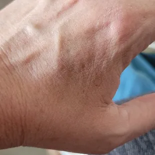 Big bruise after getting manicure