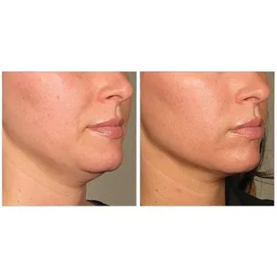 Ultherapy Before &amp; After