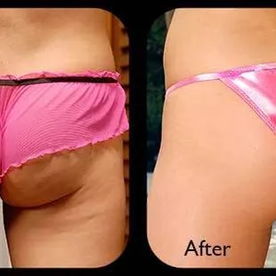 Electro-Slim Treatments