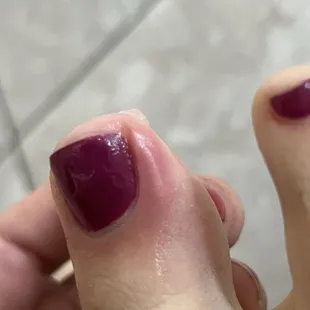 Ingrown from cutting down side.