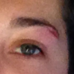 roommate who split her eye open after falling down the unstable concrete stairs