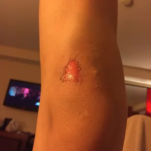 my knee after four days of healing from falling up the concrete stairs