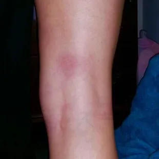 the bite will eventually go on to have her thigh swollen