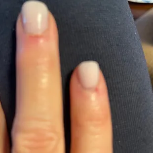 Painful and Bleeding cuticles