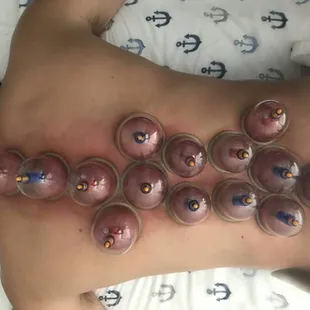 Cupping massage