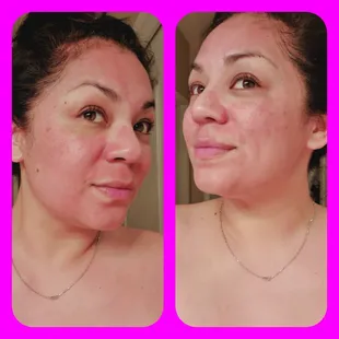 Right after my Microneedling.  This is my 3rd treatment and absolutely love it. My skin gets better and better each time