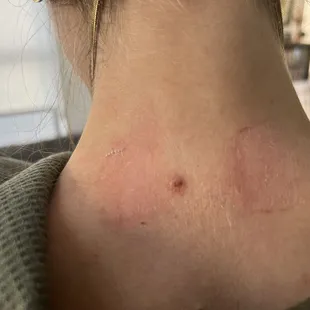 A week after mole removal. Today, there is nothing left. Just my flat skin!