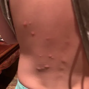 Bed bug bites