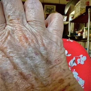 Bruise from IV not placed correctly