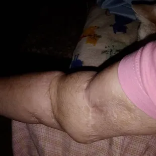 This is my arm. The middle part is my leg that was used to put arm back together