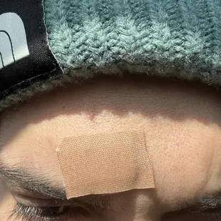 My treated wound btw best food you'll ever have