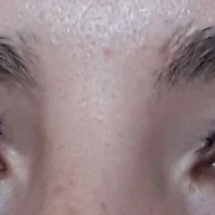 Day 1 day of surgery upper blepharoplasty