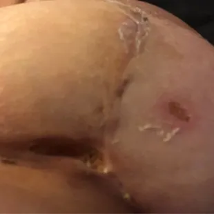 Hole in my breast and infection