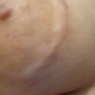 The scars i ended up with after Dr.Chen did a breastlift on me.