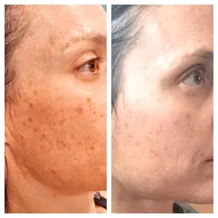 Before and 10 days after