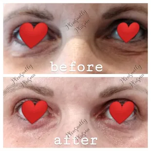 under eyes 1 treatment