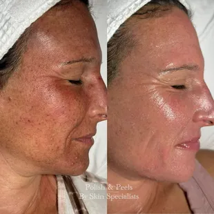 Pigmentation Revision