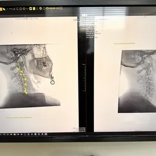 My neck before and after!
