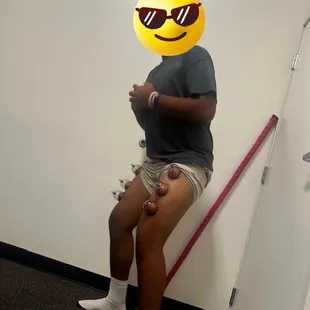 Myofascial Decompression (Cupping)