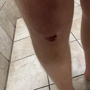 a person's leg with a wound on it