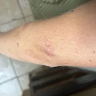 a man's arm with a bruise on it