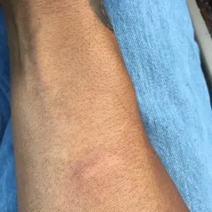 Bed bug bites