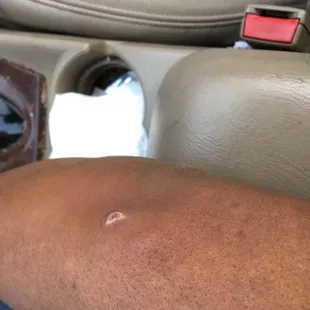 Bed bug bite next to my burn scab