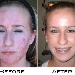Before and after acne treatment