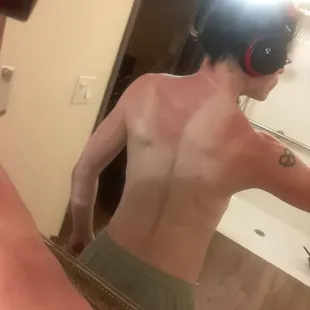 Weeping blistered sunburn from being made to stand in the sun after being ejected from the grounds after checking out